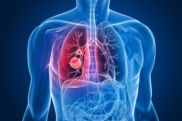 A New Artificial Intelligence Can Help Diagnose Lung Cancer a Year Early