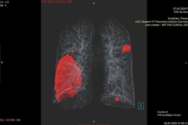 Covid-19 : L'hôpital Foch utilise l'intelligence artificielle pour détecter les lésions pulmonaires