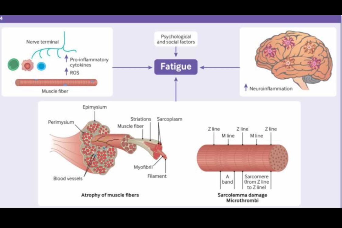 Long covid—mechanisms, risk factors, and management