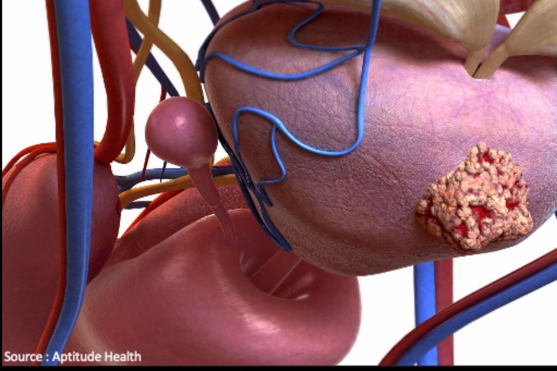 The Future of Imaging in Prostate Cancer