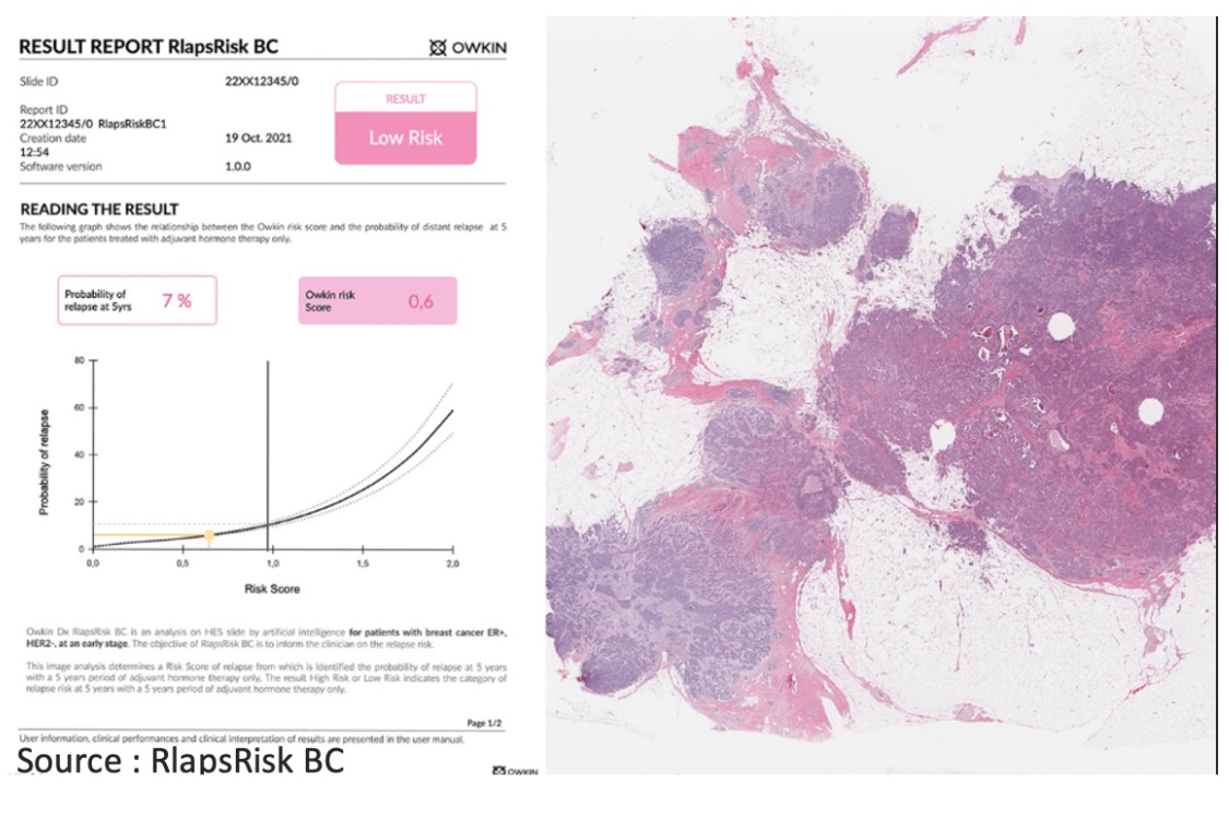 Owkin veut améliorer la prise en charge des cancers du sein et colorectal grâce à l'analyse d'images