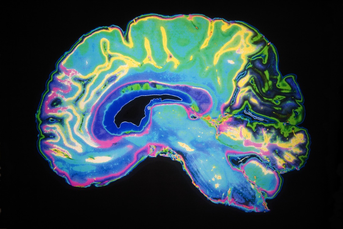 Des chercheurs utilisent l'intelligence artificielle pour explorer les origines cellulaires de la maladie d'Alzheimer et d'autres troubles cognitifs