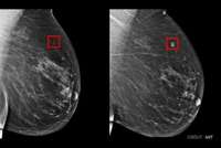Cancer du sein : l’IA permet la détection de nombreux cas autrement passés inaperçus, selon une étude en conditions réelles