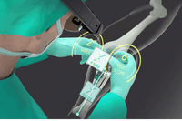 La FDA autorise le guidage 3D de Pixee Medical pour la chirurgie du genou