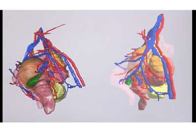 La 3D au service de l'endométriose (Journée mondiale de sensibilisation à l'endométriose)