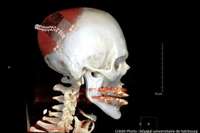 Une prothèse crânienne imprimée en 3D a été implantée chez un patient